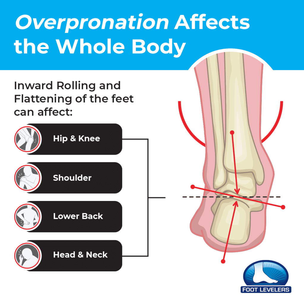 Overpronation Affects the Whole Body